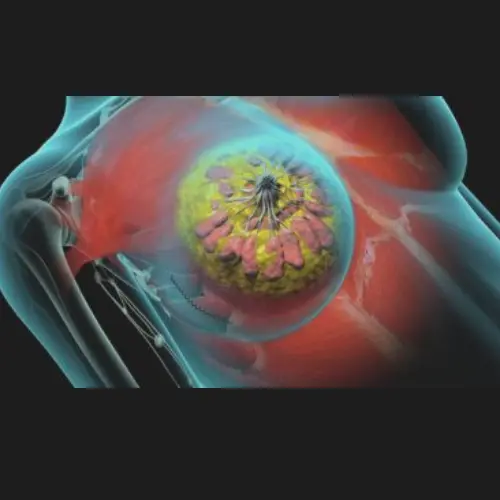 Breast Tumor Removal by VABS