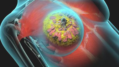 Breast Tumor removal