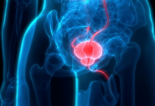 Prostatic Artery Embolization