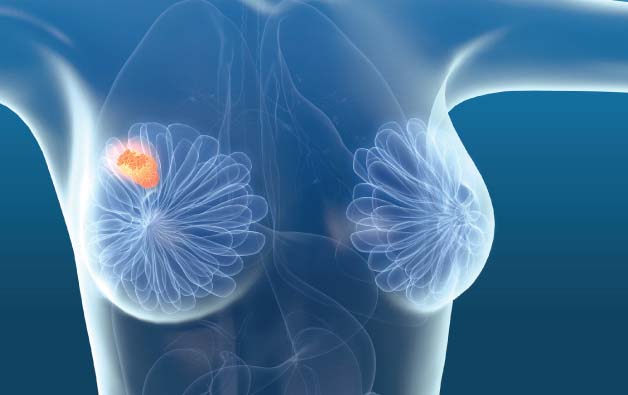 Breast Tumor Removal by VATS in Delhi