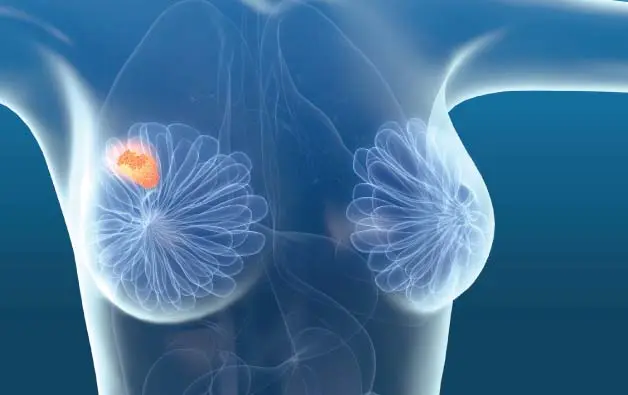 breast lump removal surgery