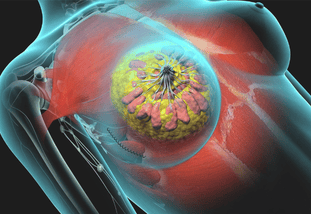 breast tumor removal by VATS