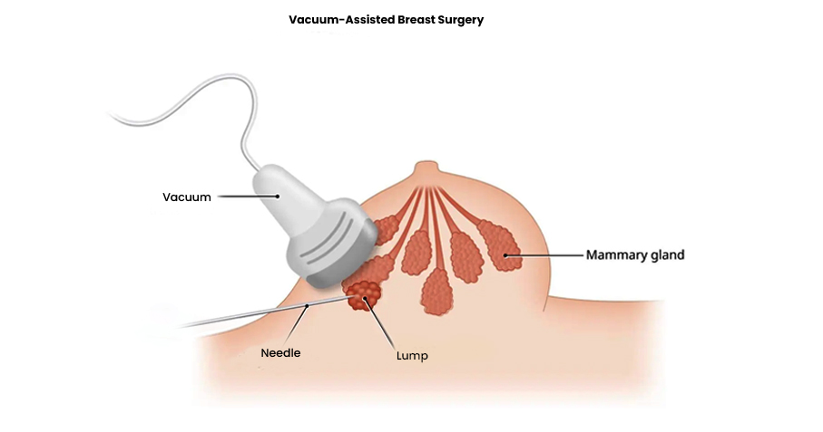 Breast Tumor Removal by VATS