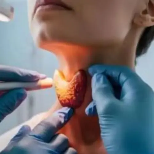 Thyroid Artery Embolization 1