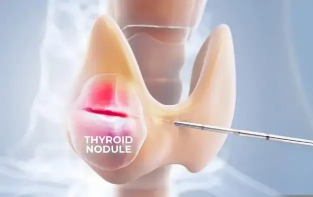Thyroid Artery Embolization In Bangalore 1