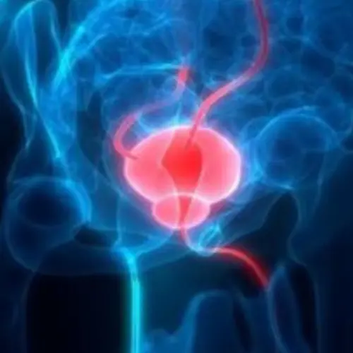 Prostatic Artery Embolization