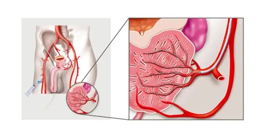 Prostatic Artery Embolization Bangalore 1