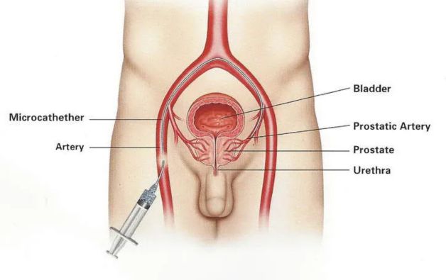 Prostatic Artery Embolization in Bangalore