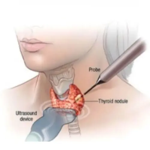 Thyroid Ablation