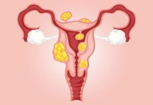 Uterine Fibroid Treatment in Bangalore