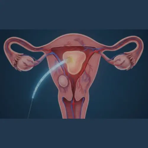 Uterine Fibroid Treatment