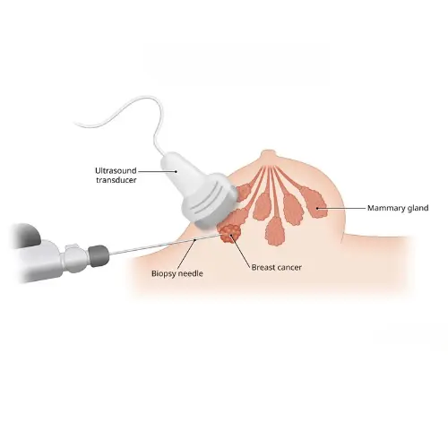 Vacuum Assisted Biopsy System