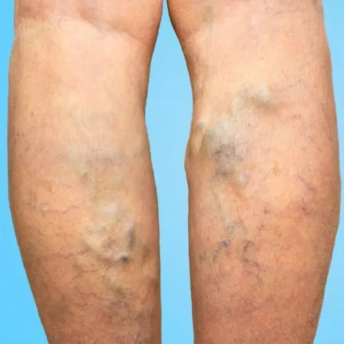 Varicose Veins