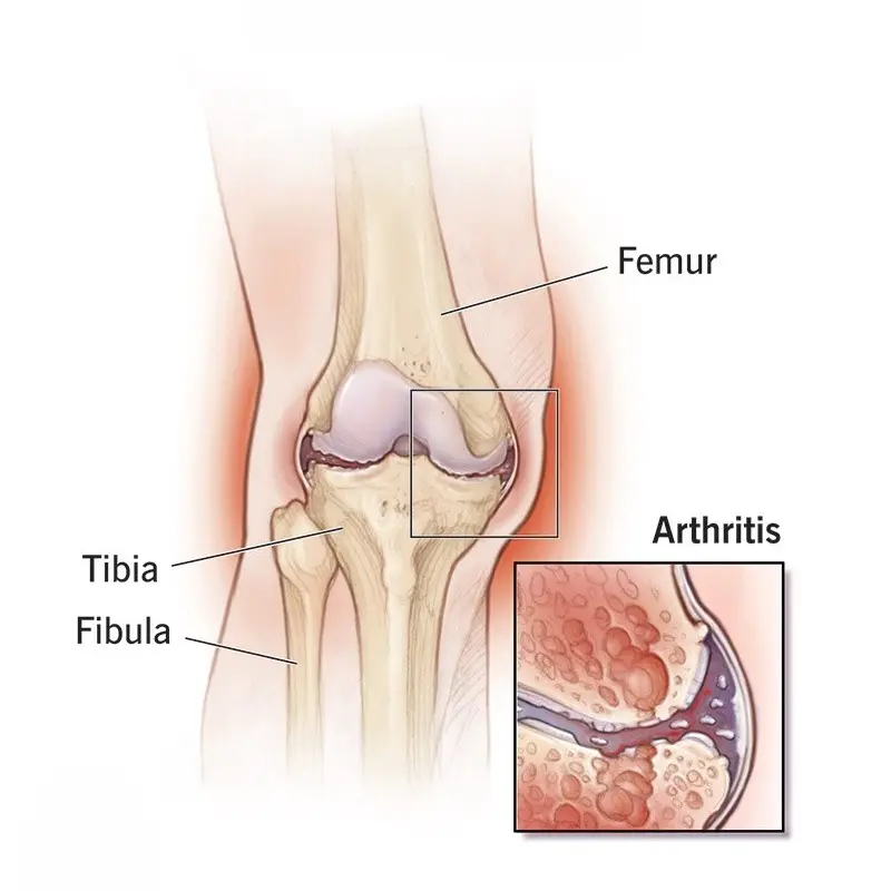 knee osteoarthritis
