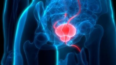 prostate artery embolization