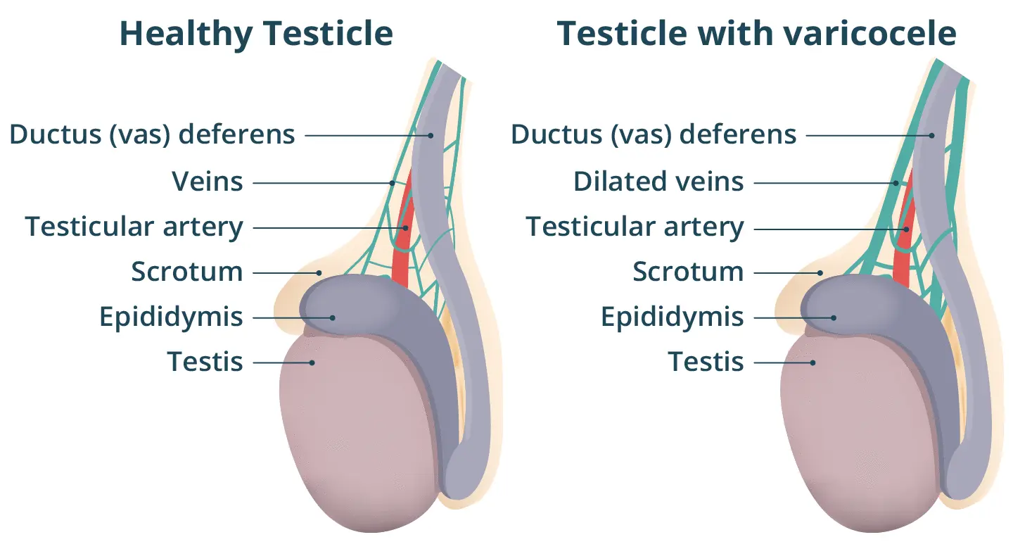 varicocele 8155af