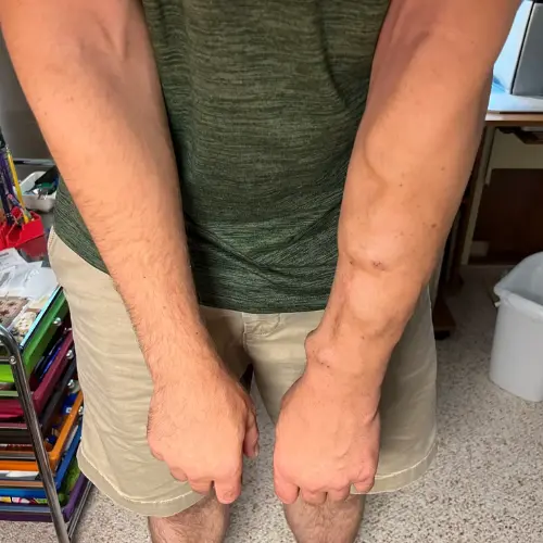 Dialysis Fistulas And Central Venous Plasty