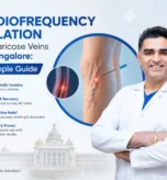 Radiofrequency Ablation for Varicose Veins in Bangalore