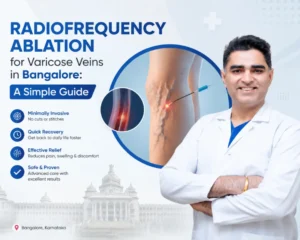 Radiofrequency Ablation for Varicose Veins in Bangalore
