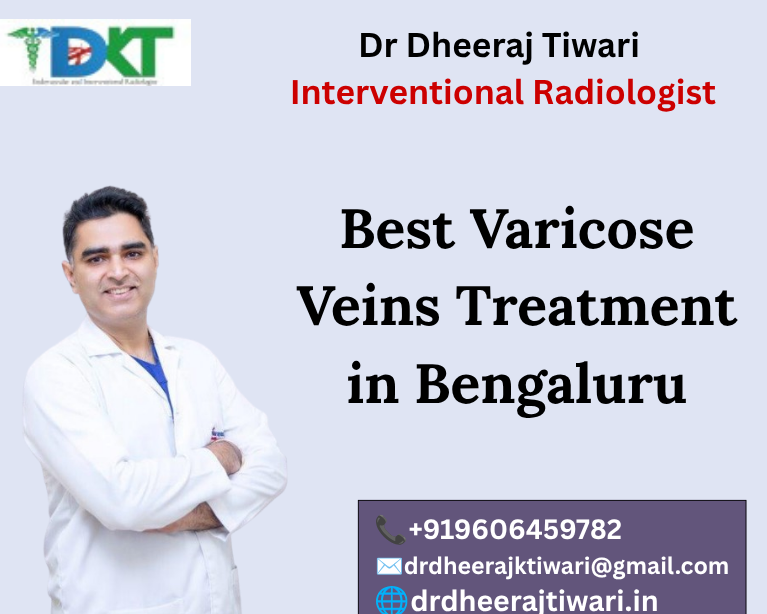 Best Varicose Veins Treatment in Bengaluru