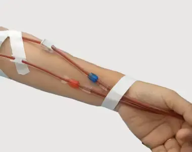 cci dialysis fistuloplasty