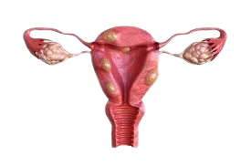 Uterine Fibroid Treatment