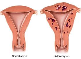 Understanding Uterine Fibroids and Heavy Bleeding