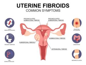 uterine fibroids