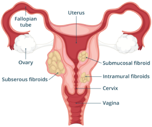 Uterine Fibroids