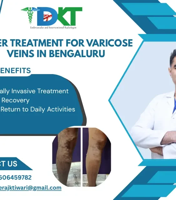 Laser Treatment for Varicose Veins in bengaluru