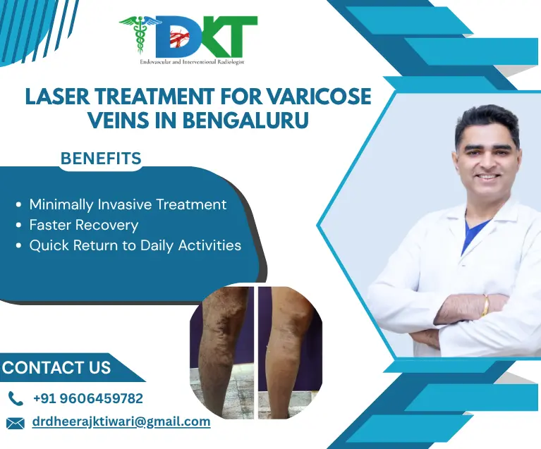 Laser Treatment for Varicose Veins in bengaluru
